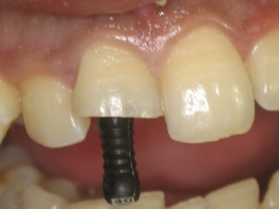 Tooth undergoing root canal treatment.