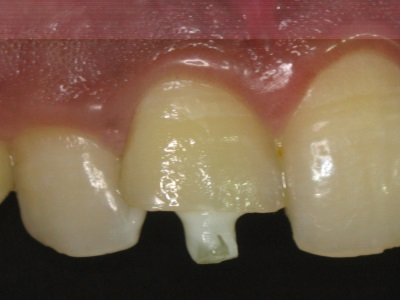 Fibre post bonded after root canal completion.