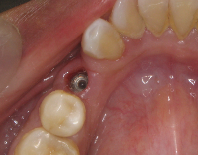 Dental implant inserted in the lower jaw-bone.