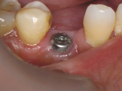Healing cap placed over dental implant to shape the gum.