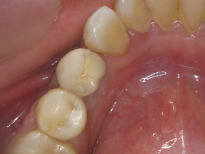 Ceramic crown fitted on the dental implant after four months of healing.