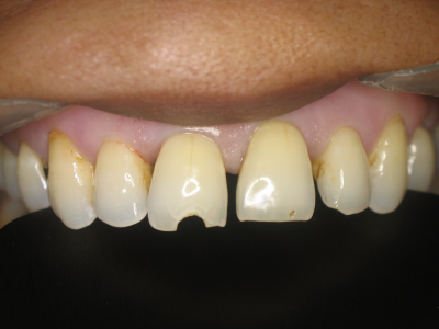 Chipped tooth with gaps.