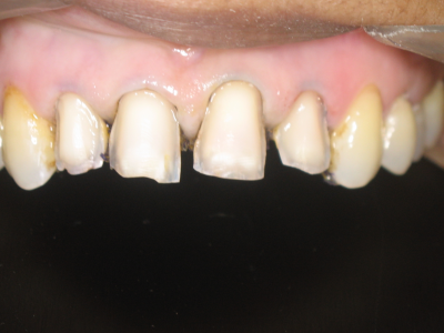 Teeth Prepared to receive Ceramic Veneers.