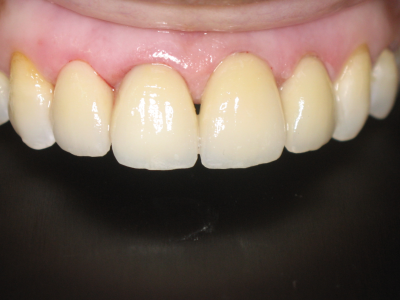 Ceramic Veneers bonded to the teeth.