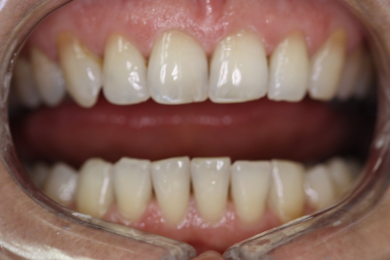 Patient had numerous fillings on front teeth that were stained and malaligned. Patient also wanted a whiter smile.