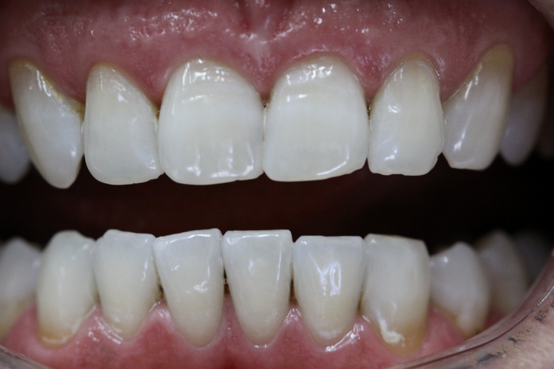 Teeth were aligned to create a better smile and shade of teeth were changed according to patient's liking and acceptance.