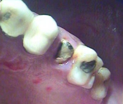 Decayed broken tooth.