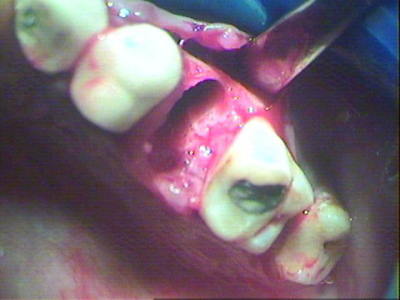 Tooth completely removed.