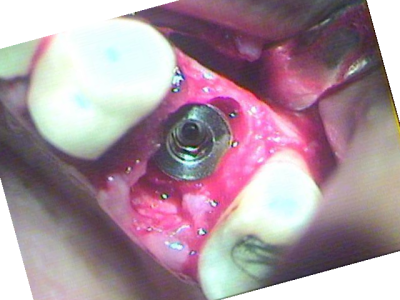 Immediate placement of dental implant.