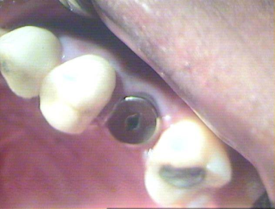 Healing cap placed on the dental implant.