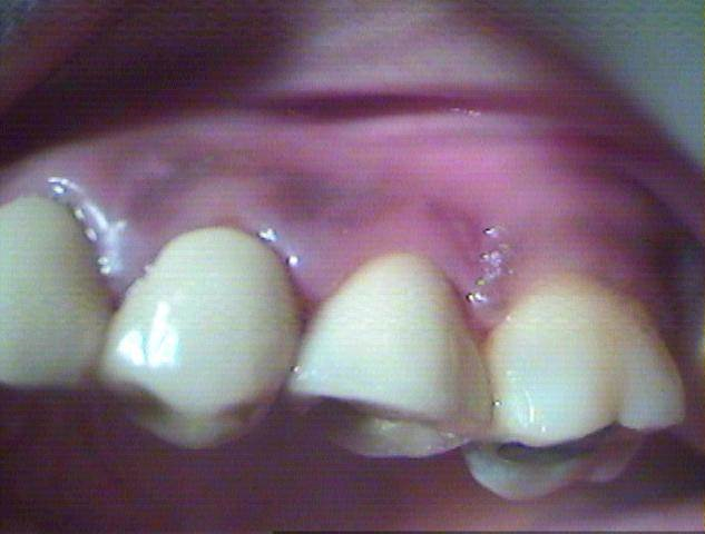 Final ceramic crown fitted on the dental implant after five months of healing.