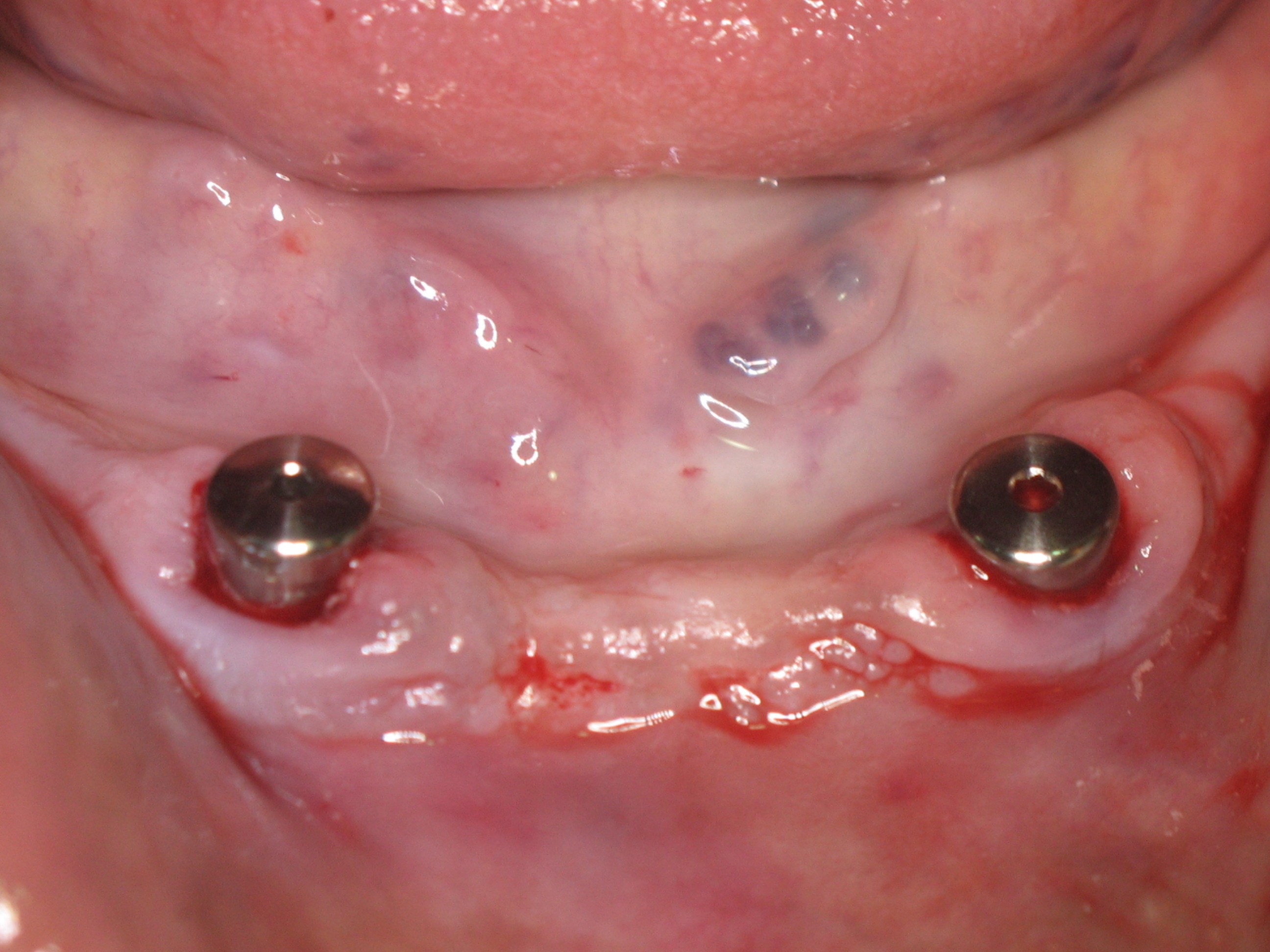 Dentures can also be stabilised by locators fitted to dental implants.